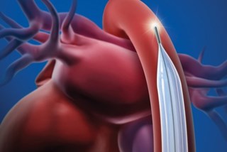 sensation plus iab catheter illustration