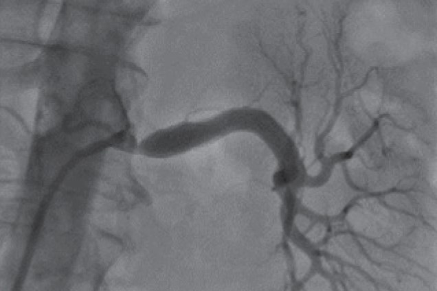 Renal artery stenosis - pre restoration